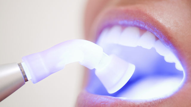 laser-blanchiment-dents