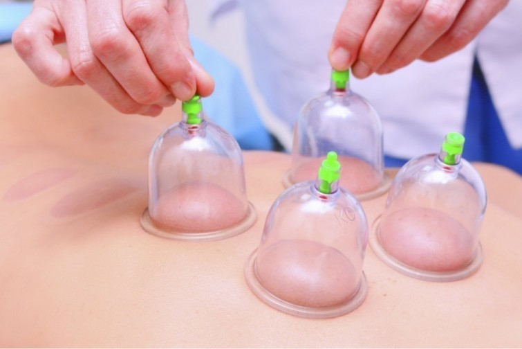 ventouses en médecine traditionnelle chinoise